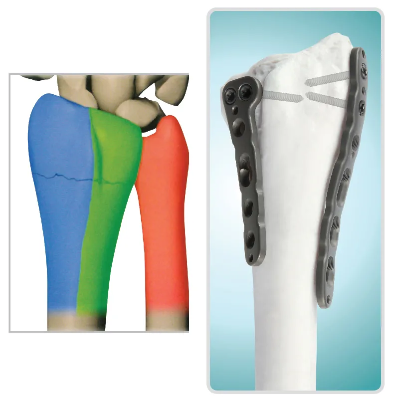 Multi-Axial Distal Radial Volar Locking Plate