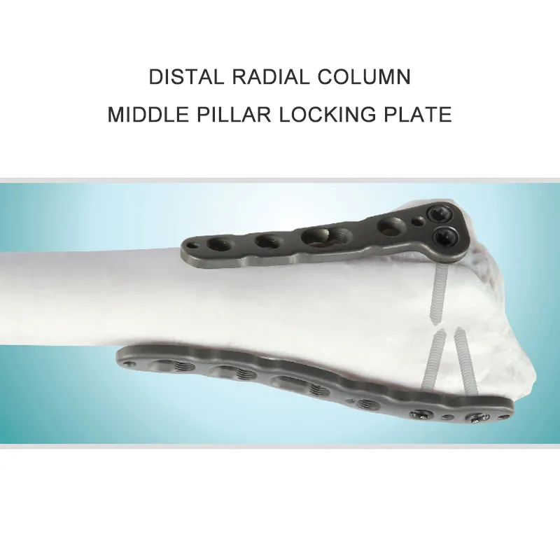 Multi-Axial Distal Radial Volar Locking Plate