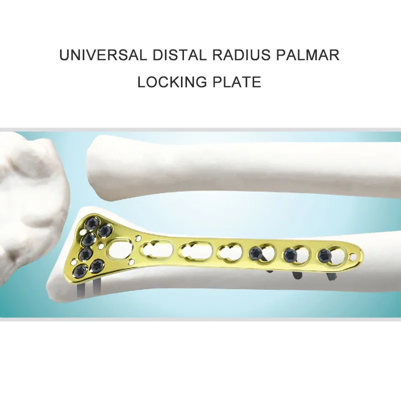 Multi-Axial Distal Radial Volar Locking Plate