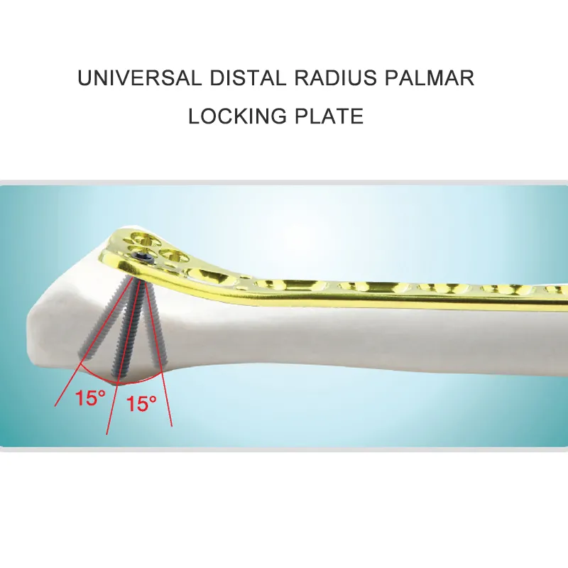 Multi-Axial Distal Radial Volar Locking Plate